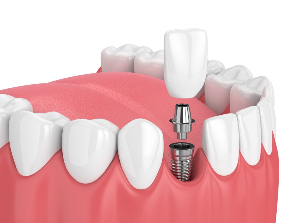 Single Tooth Implant Cost With vs Without Insurance